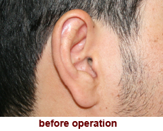 plastic-surgery-prominent-ear 